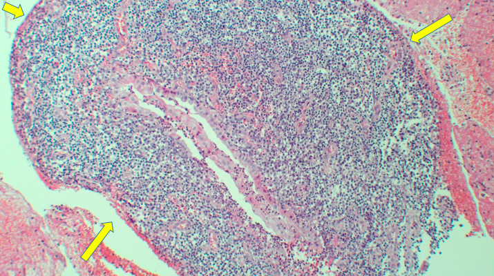Fístula gastropancreática secundária a neoplasia intraductal mucinosa papilar pancreática
