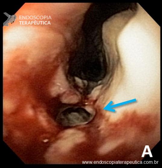 Endoscopia demonstrando neoplasia esofágica e orifício de fístula esofagorespiratória (seta).