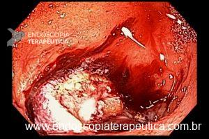 Ressecção endoscópica de parede total Figura 5 – Exerese da lesão