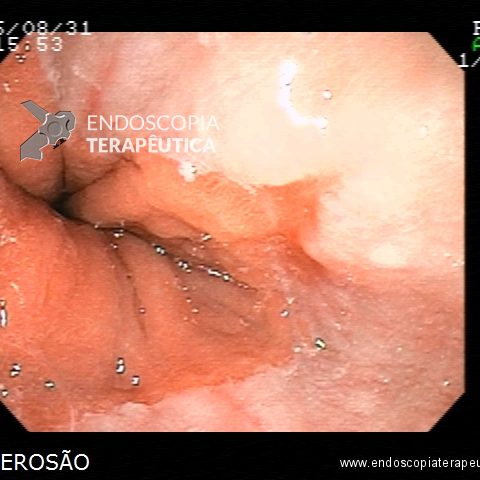 Esofagite Erosiva por Doença do Refluxo • Endoscopia Terapeutica