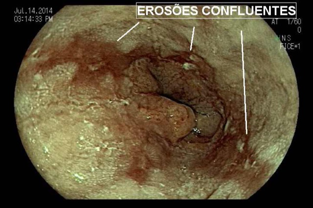 Esofagite Erosiva - Los Angeles • Endoscopia Terapeutica