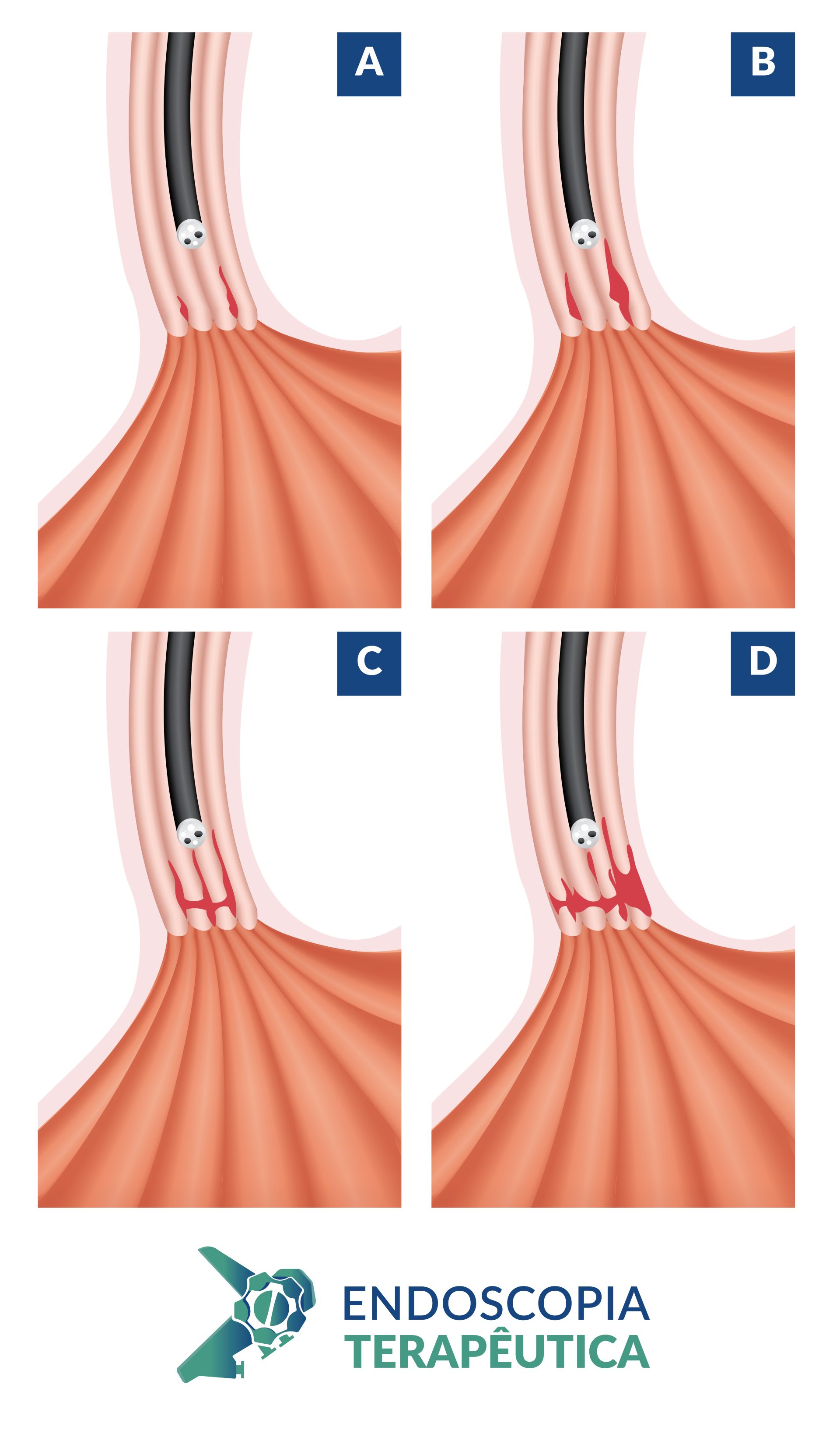 Esofagite Erosiva - Los Angeles • Endoscopia Terapeutica