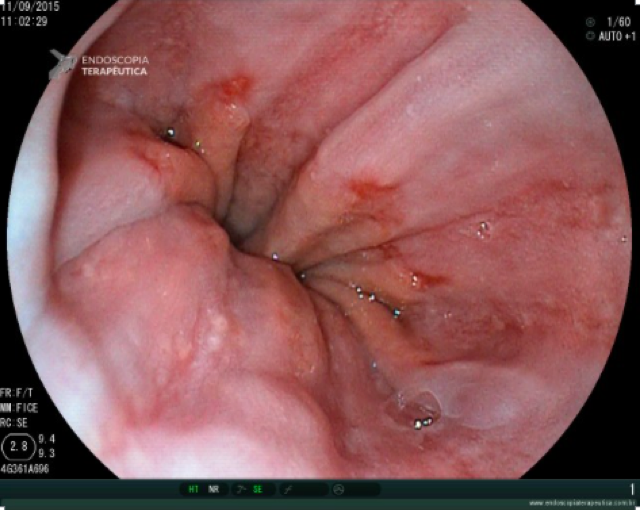 o que é esofagite erosiva grau A de Los Angeles