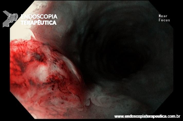 Carcinoma Neuroendócrino de Esôfago