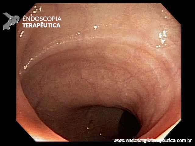 Doença de Crohn com acometimento esofágico