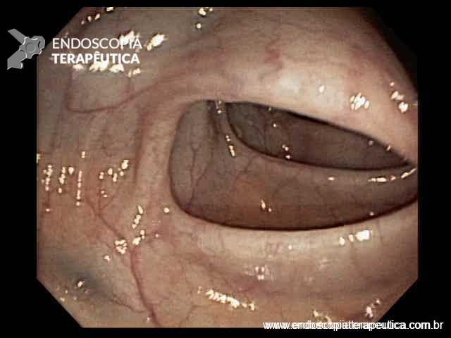 Doença de Crohn com acometimento esofágico