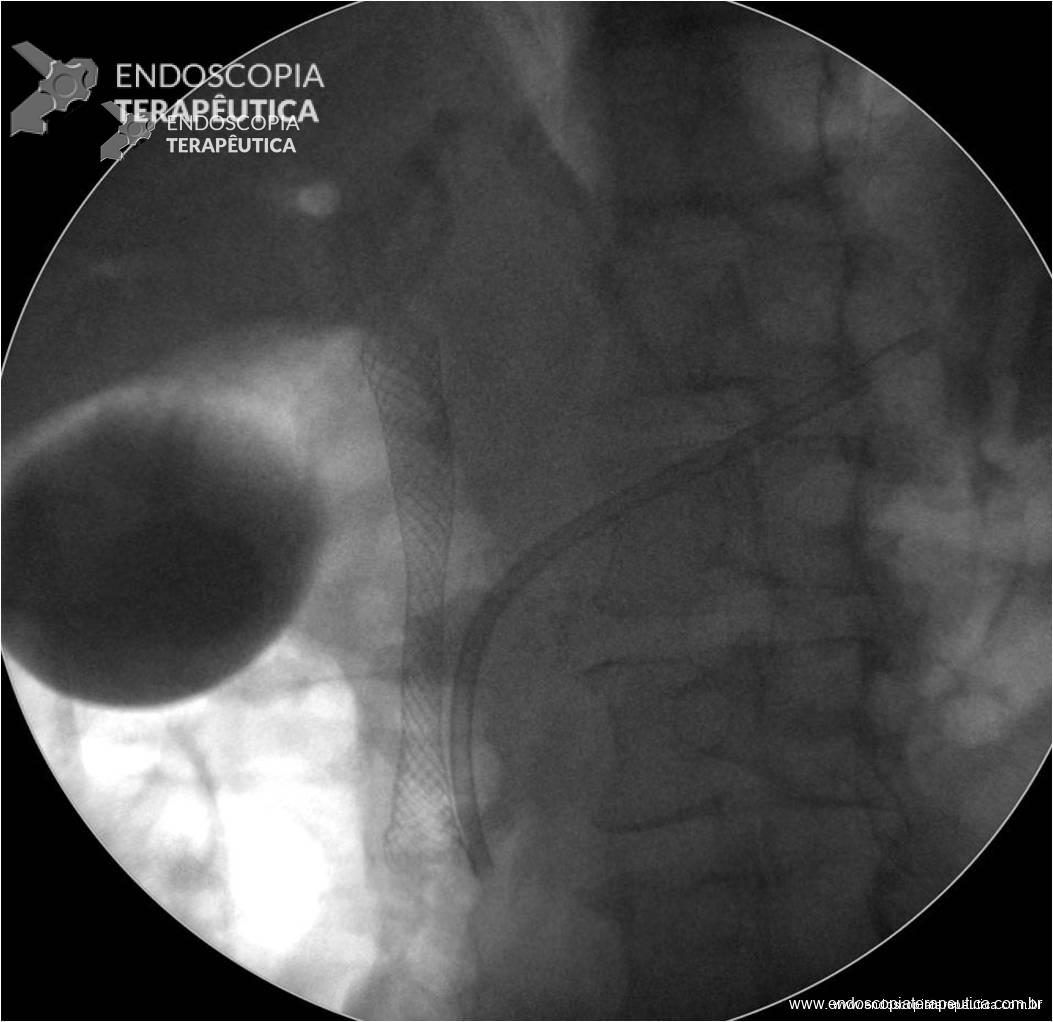 Tratamento endoscópico da pancreatite crônica. Radioscopia demonstrando prótese metálica biliar e prótese plástica em posição pancreática.