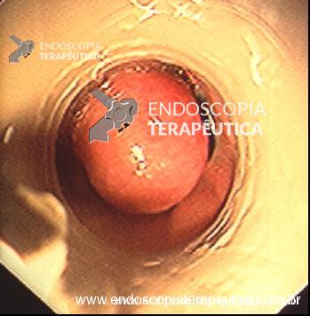 Figura: ligadura elástica de variz esofágica.