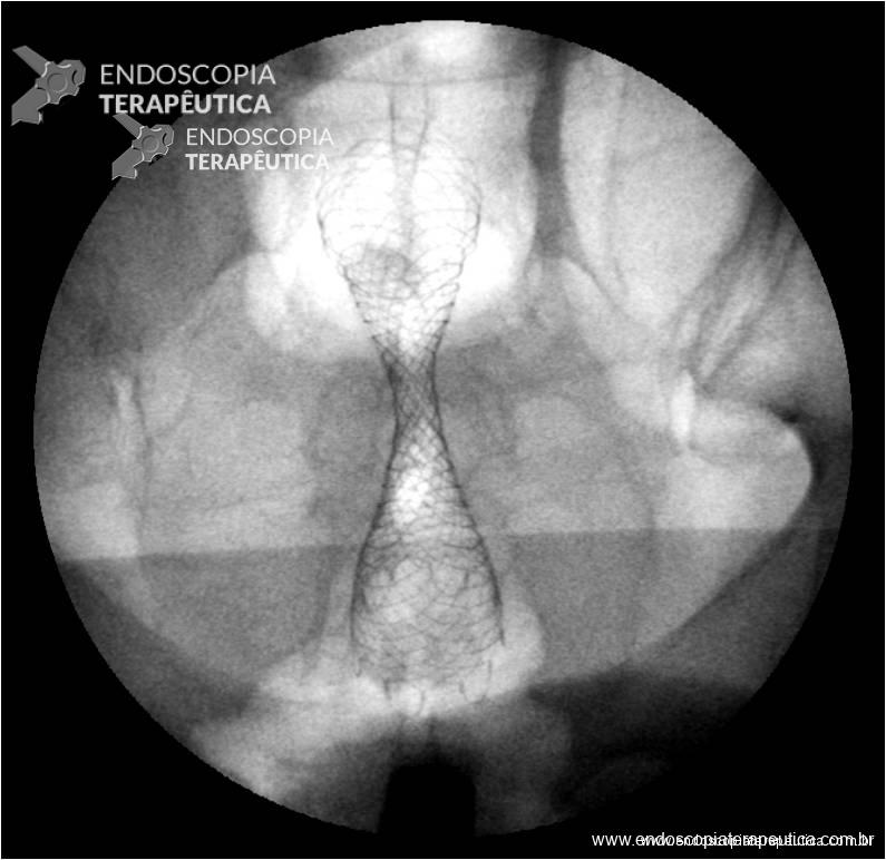 Radioscopia exibindo cintura no meio da prótese dada pela estenose tumoral. 