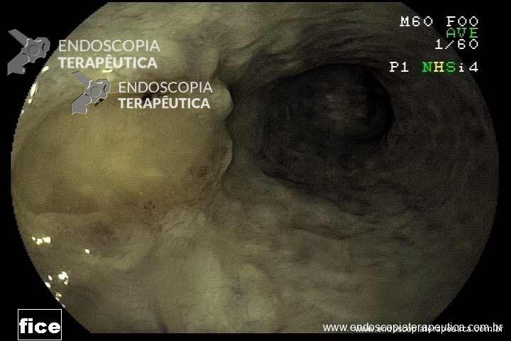 ulcera2