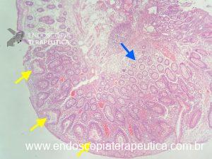 Notam-se glândulas dilatadas e preenchidas por mucina setas amarelas_glandulas normais seta azul