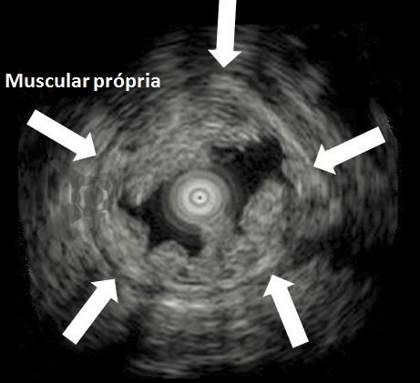Mucosectomia underwater evidenciando flutuação da mucosa e submucosa