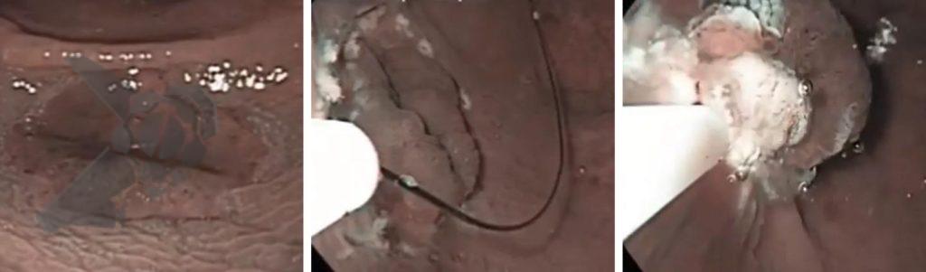 Mucosectomia underwater para lesão plana do cólon sem injeção submucosa