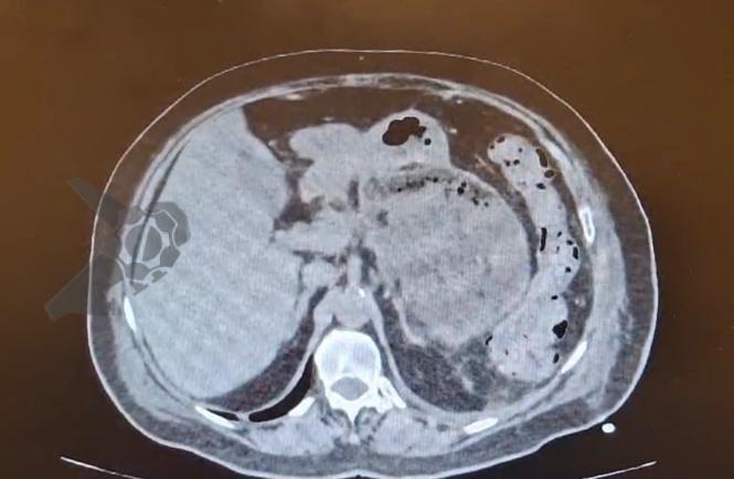 Coleção Necrótica Peripancreática