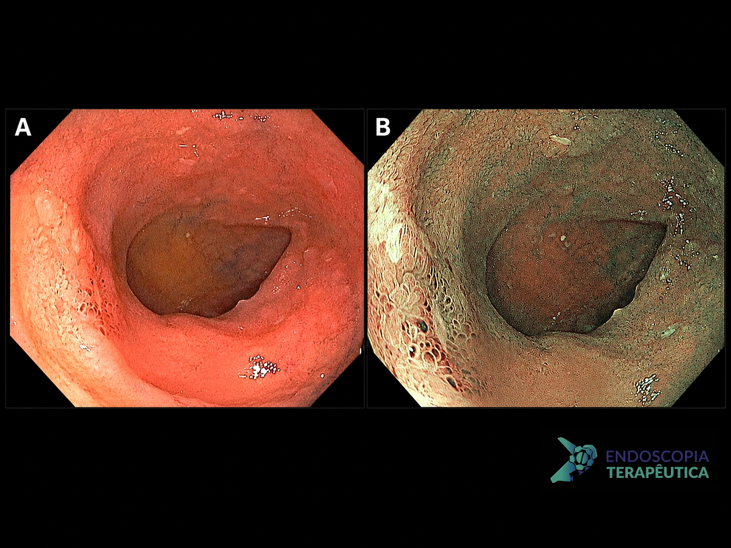 Linfoma intestinal- MALT em íleo terminal