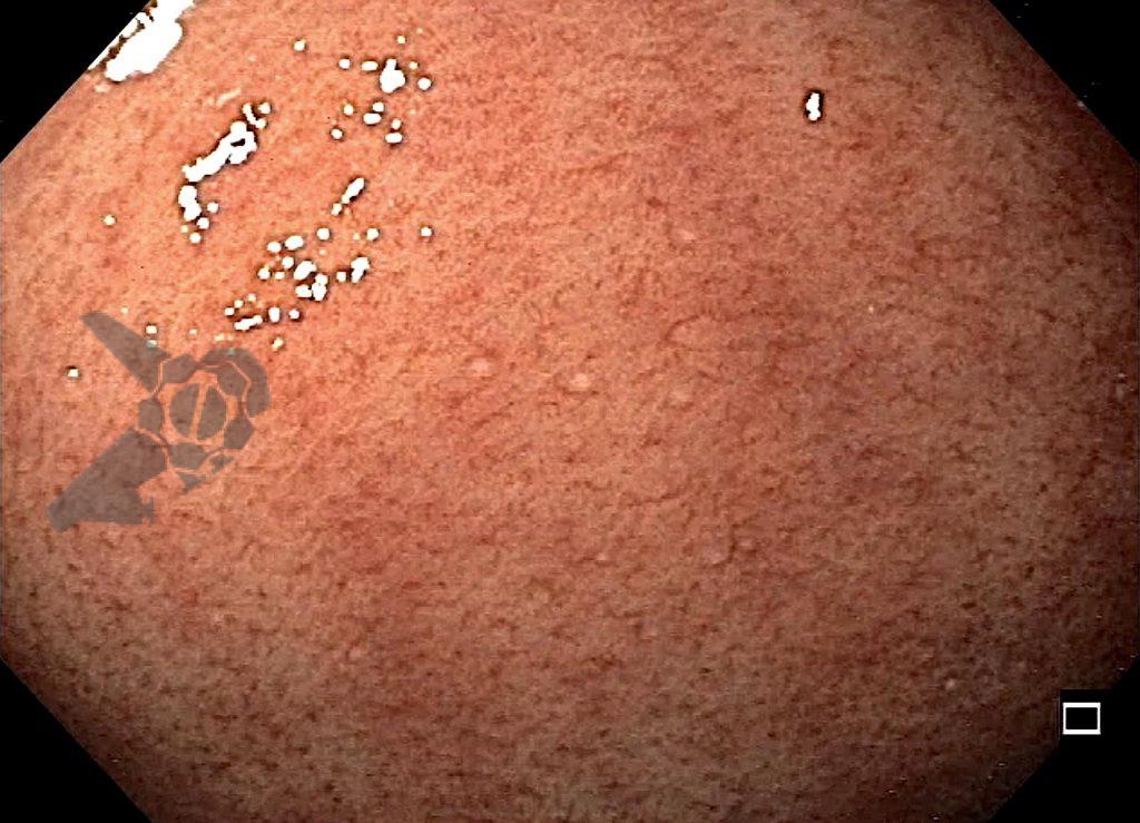 Achados gástricos com uso de vonoprazana