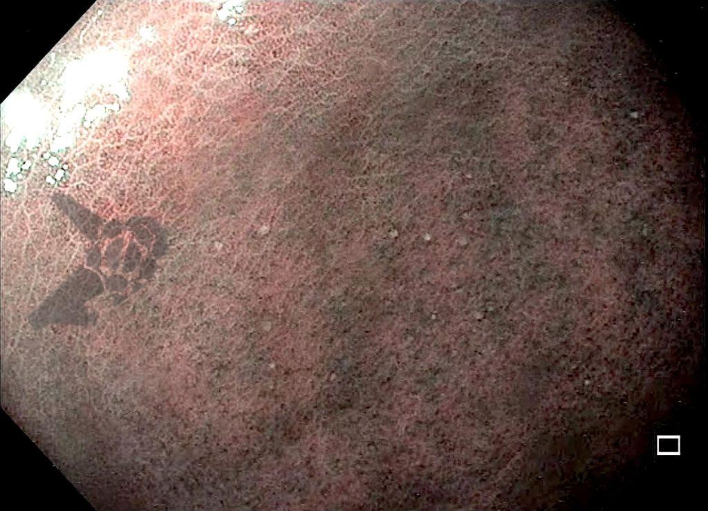 Achados gástricos com uso de vonoprazana