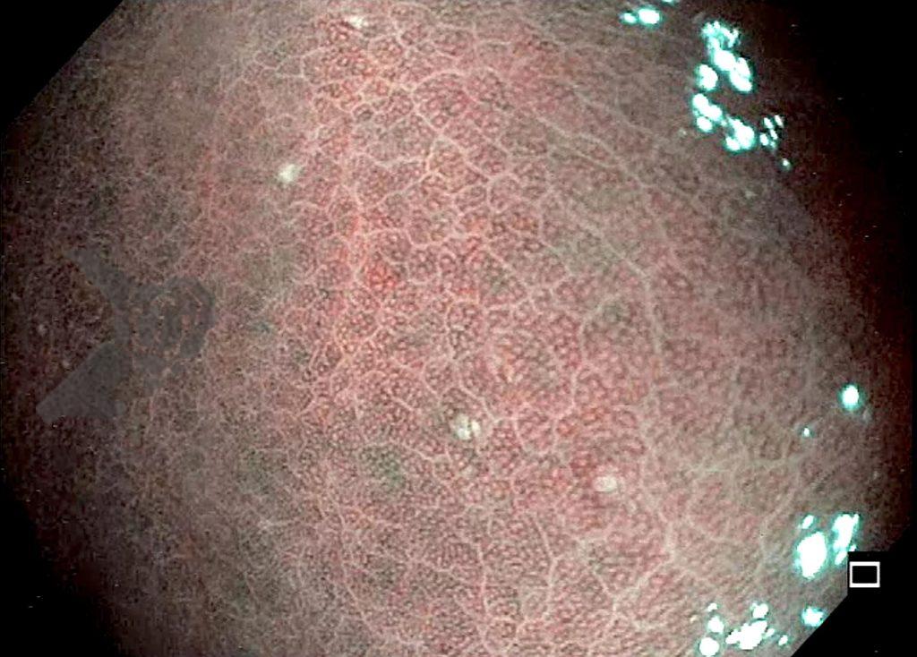 Achados gástricos com uso de vonoprazana