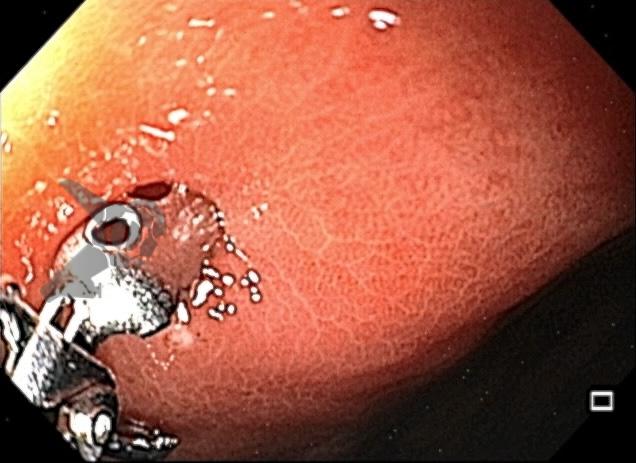 Achados gástricos com uso de vonoprazana