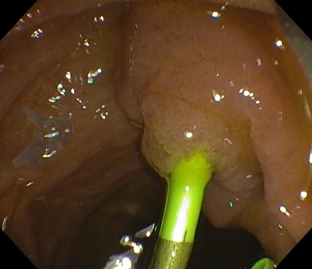 Canulação Pancreática e Pancreatite pós-CPRE- Prótese pancreática tipo single pigtail transpapilar