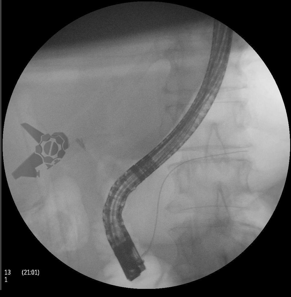 Canulação Pancreática e Pancreatite Pós-CPRE: Cateterização do ducto pancreático principal