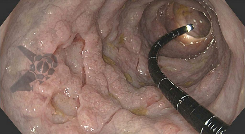 Avaliação do intestino delgado na suspeita de doença inflamatória